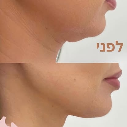 חומצה היאלורונית